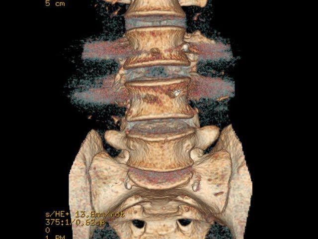 A Case of Double Failed Lumbar Fusion and Dangerously Misplaced Pedicle Screws